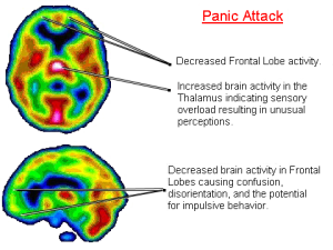 Attivazione dell’ansia e della paura nel cervello